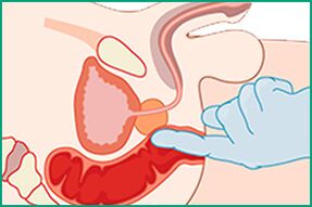 Masaža prostate - zdravljenje prostatitisa