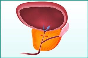 Povečanje prostate in stiskanje sečnice