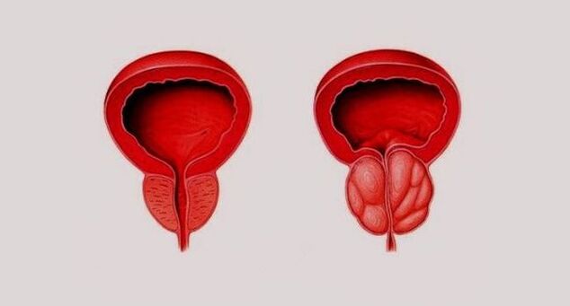 Zdrava prostata (levo) in vneta zaradi prostatitisa (desno)