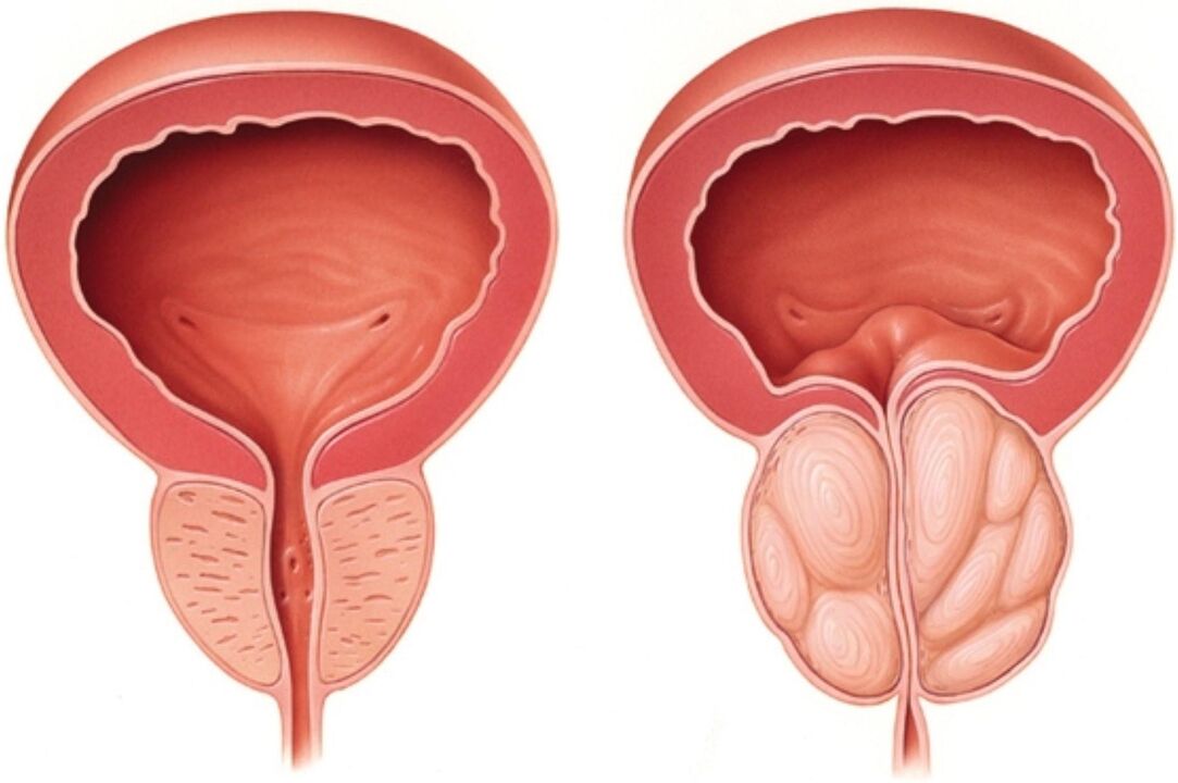 Normalna prostata (levo) in z znaki vnetja pri prostatitisu (desno)