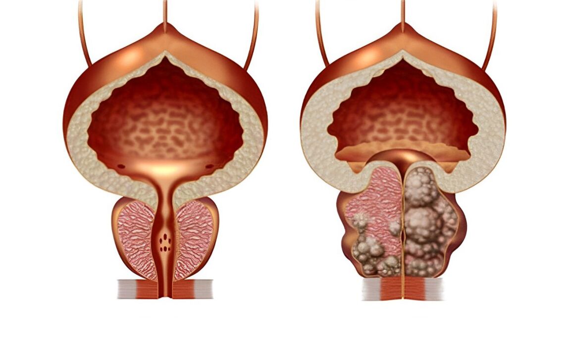 kako izgleda adenom prostate 