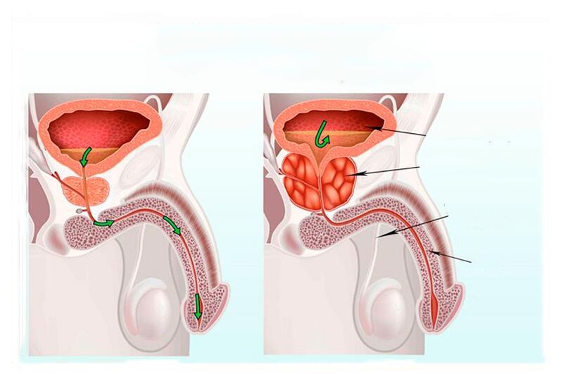 norma in vnetje prostate