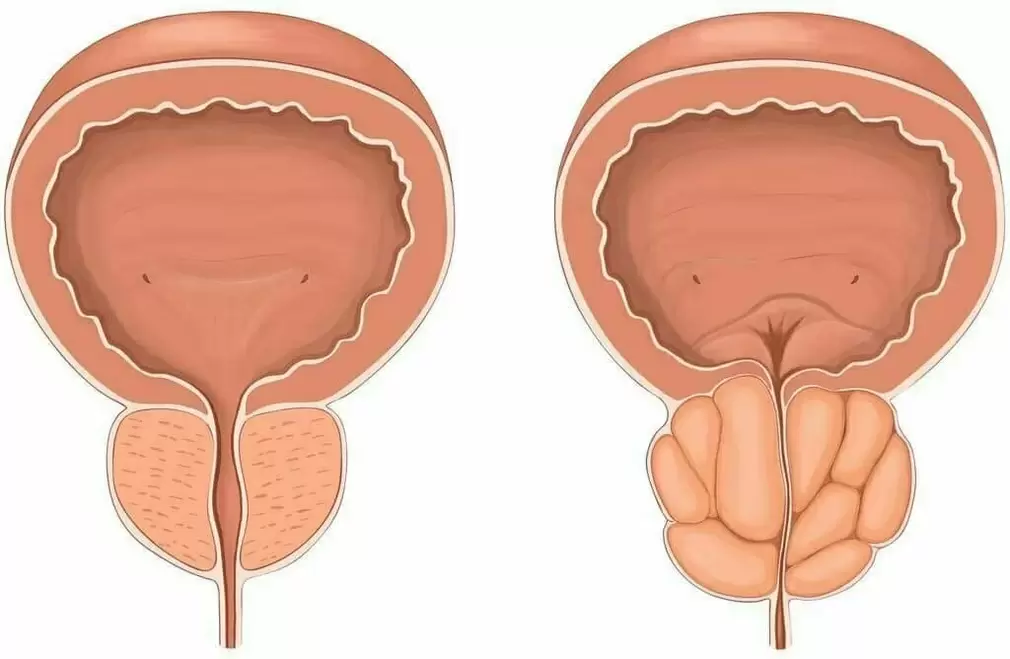 Običajna prostata in vneta prostata