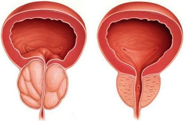 zdrava in vneta prostata s prostatitisom